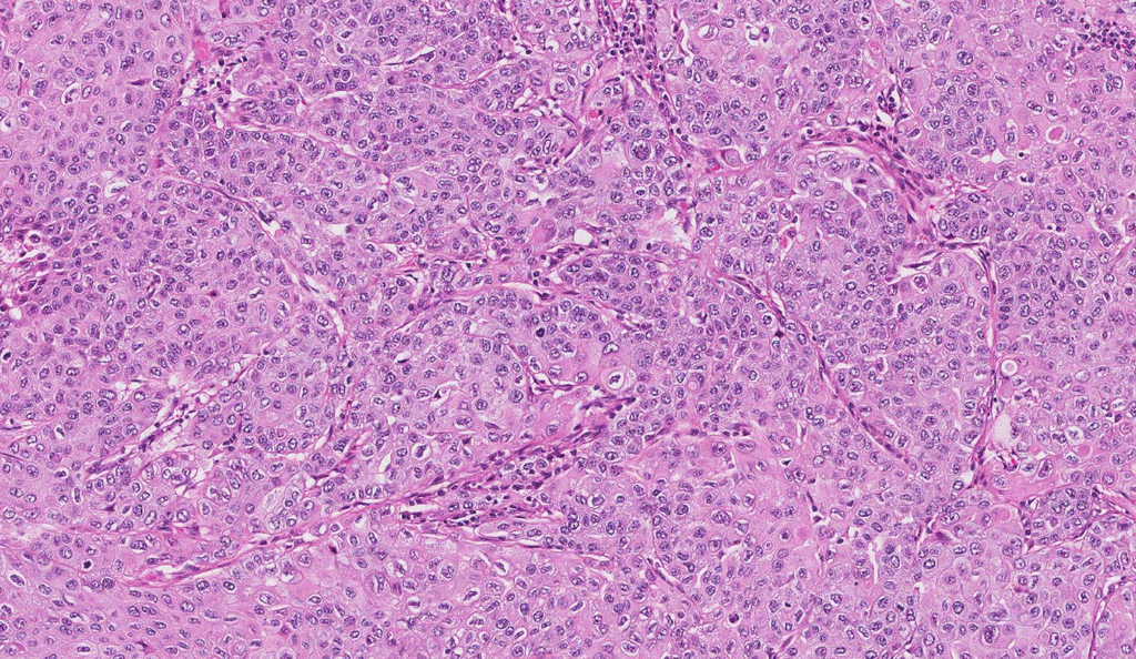 Human Lung Cancer ''Squamous cell carcinoma ''grade I'' of superior lobe of right lung'' ''single section per slide''   5 slides/pack